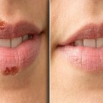 Can Cold Sore Patches Speed Up The Healing Process?